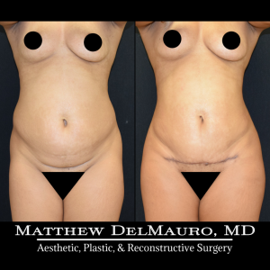 Before-After-3.75-Months-–-Liposuction-of-Abdomen-Waist-Flanks-Abdominal-Scar-Revision-Fat-Grafting-to-Bilateral-Hips2