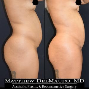 Before-After-3.75-Months-–-Liposuction-of-Abdomen-Waist-Flanks-Abdominal-Scar-Revision-Fat-Grafting-to-Bilateral-Hips4