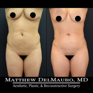 Before-After-11-Months-–-Lipo-360-BBL1