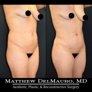 Before-After-11-Months-–-Lipo-360-BBL2