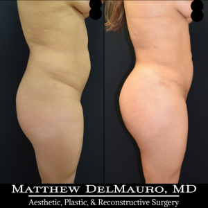 Before-After-11-Months-–-Lipo-360-BBL3