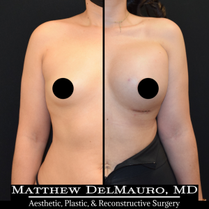 Before-After-1-Months-–-Breast-Augmentation-Silicone1