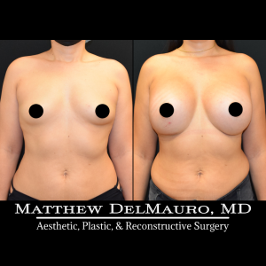 Before-After-1-Months-–-Breast-Augmentation-Silicone2