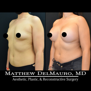 Before-After-1-Months-–-Breast-Augmentation-Silicone3