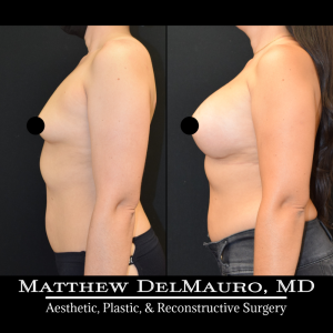 Before-After-1-Months-–-Breast-Augmentation-Silicone4