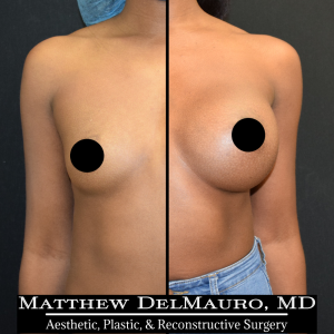 Before-After-1-Years-–-Breast-Augmentation-Silicone1