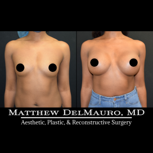 Before-After-1-Years-–-Breast-Augmentation-Silicone2