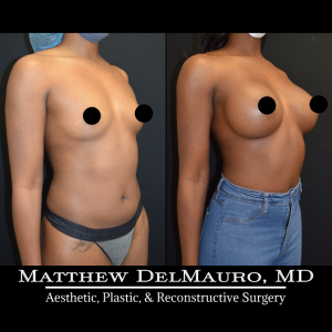 Before-After-1-Years-–-Breast-Augmentation-Silicone3