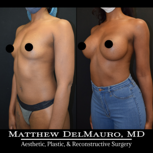 Before-After-1-Years-–-Breast-Augmentation-Silicone5