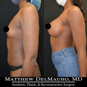 Before-After-1-Years-–-Breast-Augmentation-Silicone6