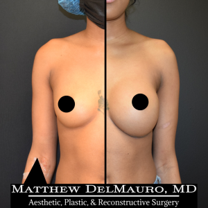 Before-After-1-Years-3-Months-–-Breast-Augmentation-Silicone1