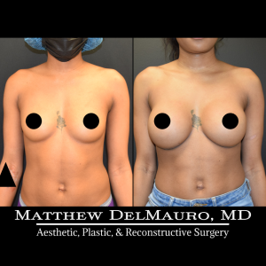 Before-After-1-Years-3-Months-–-Breast-Augmentation-Silicone2