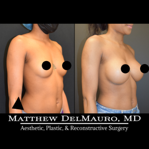Before-After-1-Years-3-Months-–-Breast-Augmentation-Silicone3