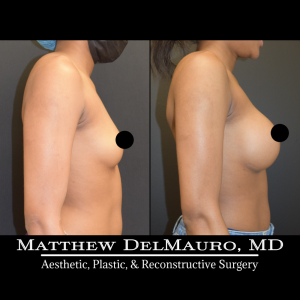 Before-After-1-Years-3-Months-–-Breast-Augmentation-Silicone4