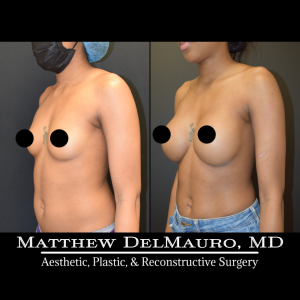 Before-After-1-Years-3-Months-–-Breast-Augmentation-Silicone5