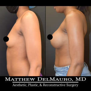 Before-After-1-Years-3-Months-–-Breast-Augmentation-Silicone6