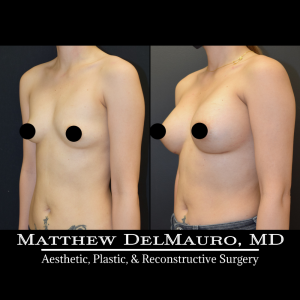 Before-After-10-Months-–-Revision-Breast-Augmentation-Silicone4
