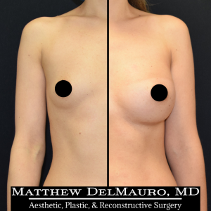 Before-After-11-Months-–-Breast-Augmentation-Silicone1