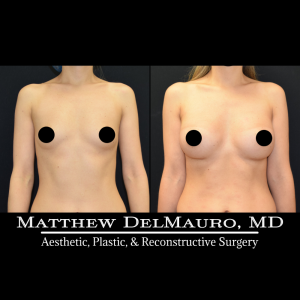 Before-After-11-Months-–-Breast-Augmentation-Silicone2