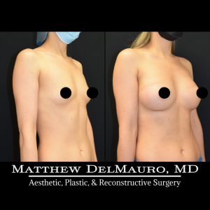 Before-After-11-Months-–-Breast-Augmentation-Silicone3
