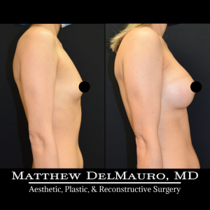 Before-After-11-Months-–-Breast-Augmentation-Silicone4