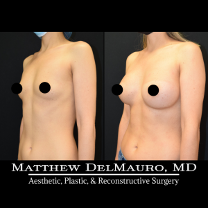 Before-After-11-Months-–-Breast-Augmentation-Silicone5