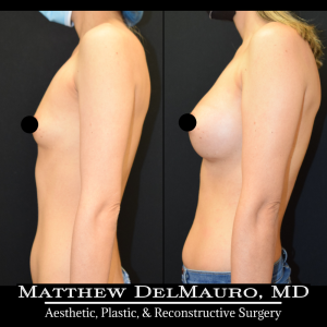 Before-After-11-Months-–-Breast-Augmentation-Silicone6