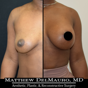 Before-After-2-Months-–-Breast-Augmentation-Silicone-Left-Circumareolar-Mastopexy1