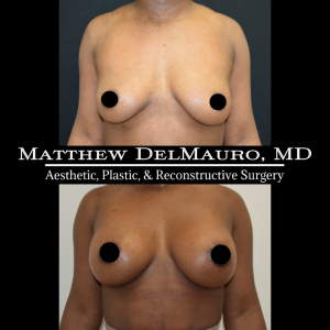 Before-After-2-Months-–-Breast-Augmentation-Silicone-Left-Circumareolar-Mastopexy2