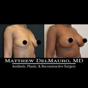 Before-After-2-Months-–-Breast-Augmentation-Silicone-Left-Circumareolar-Mastopexy3