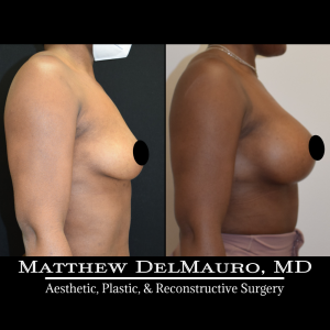 Before-After-2-Months-–-Breast-Augmentation-Silicone-Left-Circumareolar-Mastopexy4