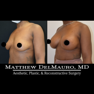Before-After-2-Months-–-Breast-Augmentation-Silicone-Left-Circumareolar-Mastopexy5