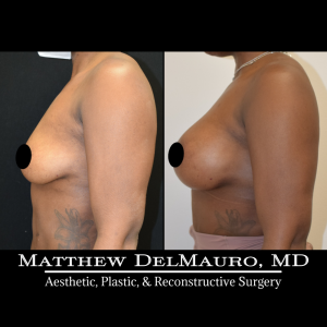 Before-After-2-Months-–-Breast-Augmentation-Silicone-Left-Circumareolar-Mastopexy6