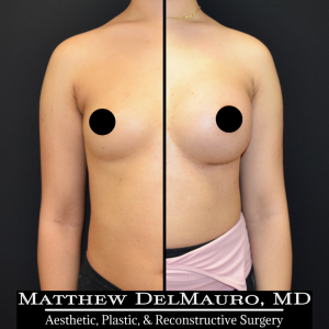 Before-After-2-Months-–-Breast-Augmentation-Silicone1