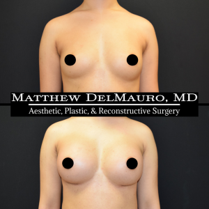 Before-After-2-Months-–-Breast-Augmentation-Silicone2