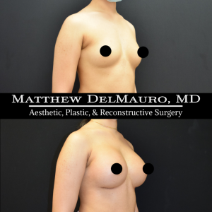 Before-After-2-Months-–-Breast-Augmentation-Silicone3
