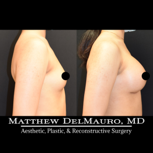 Before-After-2-Months-–-Breast-Augmentation-Silicone4