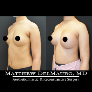 Before-After-2-Months-–-Breast-Augmentation-Silicone5