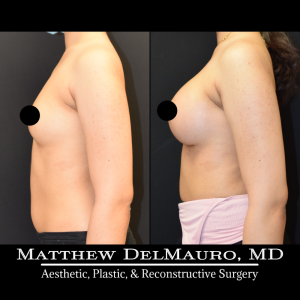 Before-After-2-Months-–-Breast-Augmentation-Silicone6