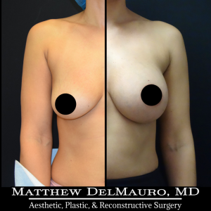 Before-After-3-Months-–-Breast-Augmentation-Saline1