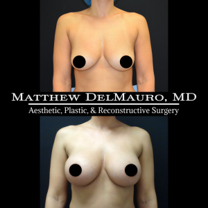 Before-After-3-Months-–-Breast-Augmentation-Saline2