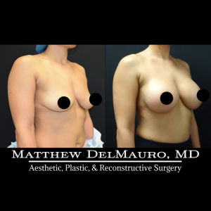 Before-After-3-Months-–-Breast-Augmentation-Saline3