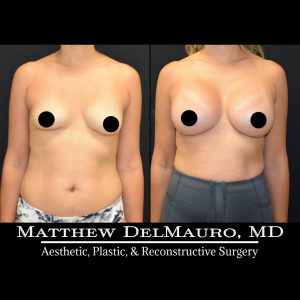Before-After-3-Months-–-Breast-Augmentation-Silicone1