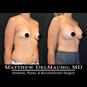 Before-After-3-Months-–-Breast-Augmentation-Silicone2