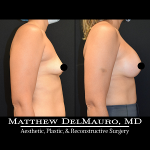 Before-After-3-Months-–-Breast-Augmentation-Silicone3