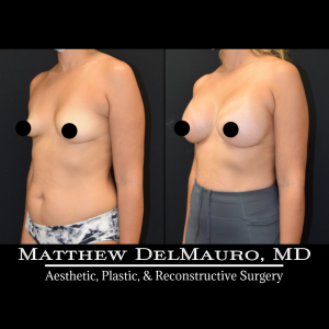 Before-After-3-Months-–-Breast-Augmentation-Silicone4