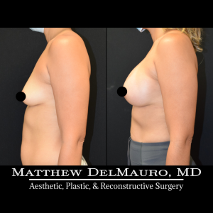 Before-After-3-Months-–-Breast-Augmentation-Silicone5