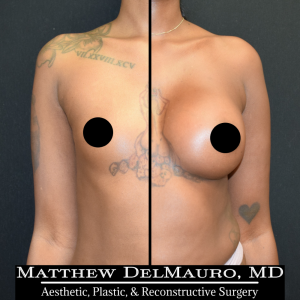 Before-After-3.5-Months-–-Breast-Augmentation-Silicone1