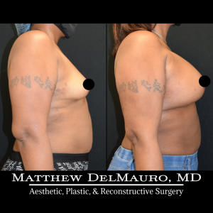 P78-Before-After-4-Months-–-Breast-Augmentation-Silicone4
