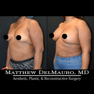P78-Before-After-4-Months-–-Breast-Augmentation-Silicone5
